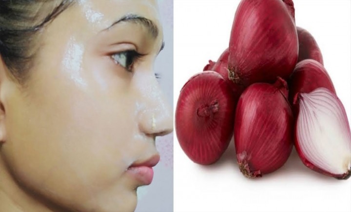 ছুলি দূর করতে জেনে নিন পেঁয়াজের ব্যবহার