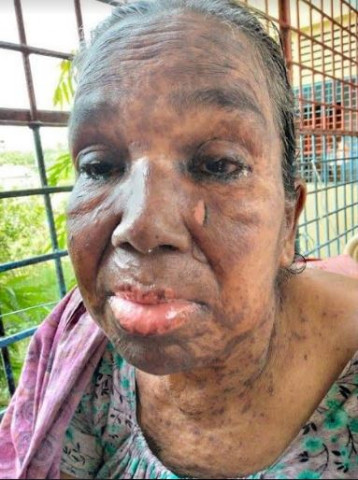 ঝিনাইদহের সমতা ডায়াগনোস্টিক সেন্টারে ডাক্তার মোকাররমের ভুল চিকিৎসায় শরীর ঝলসে মৃত্যুশয্যায় বৃদ্ধা