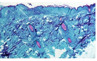আক্রান্ত বাড়লেও মাঙ্কিপক্স নিয়ন্ত্রণে রাখা সম্ভব: ডব্লিউএইচও